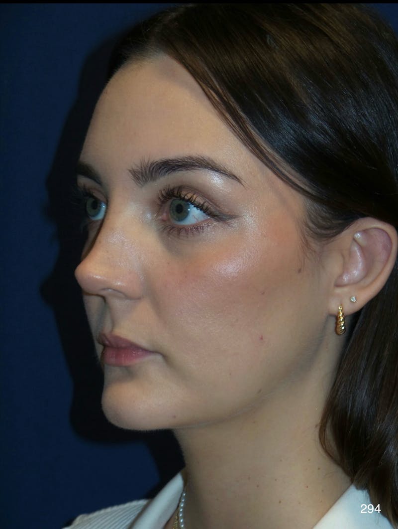 Rhinoplasty Before & After Gallery - Patient 387364 - Image 8