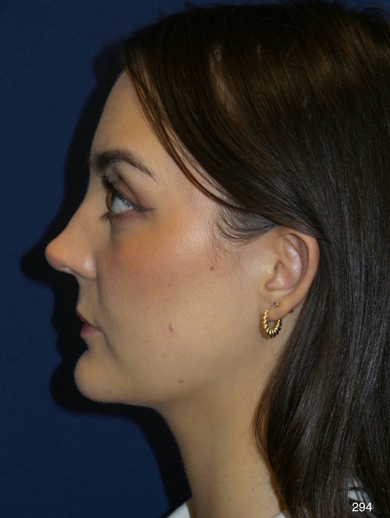 Rhinoplasty Before & After Gallery - Patient 387364 - Image 10