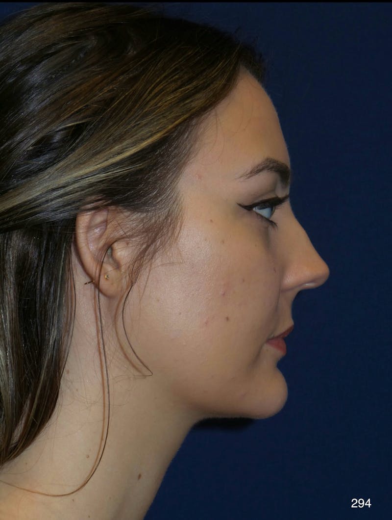 Rhinoplasty Before & After Gallery - Patient 387364 - Image 3