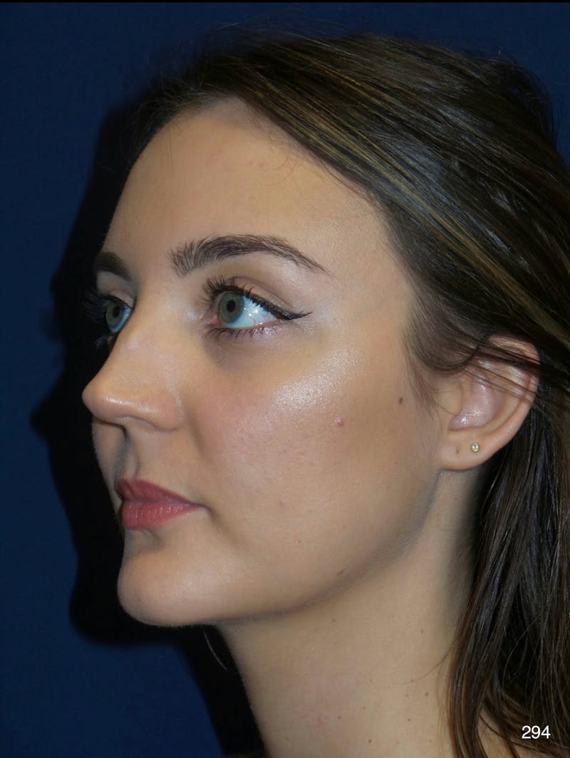 Rhinoplasty Before & After Gallery - Patient 387364 - Image 7