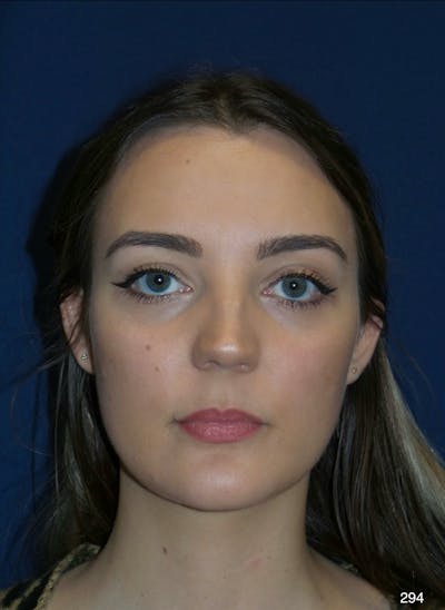 Rhinoplasty Before & After Gallery - Patient 387364 - Image 1