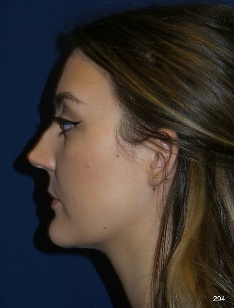 Rhinoplasty Before & After Gallery - Patient 387364 - Image 9