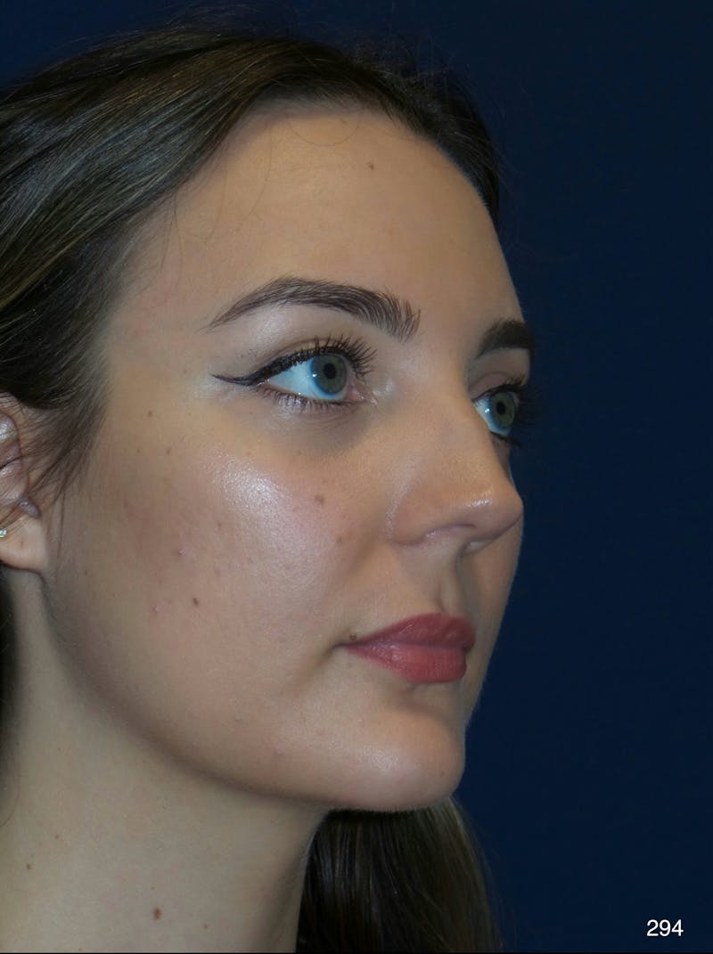Rhinoplasty Before & After Gallery - Patient 387364 - Image 5