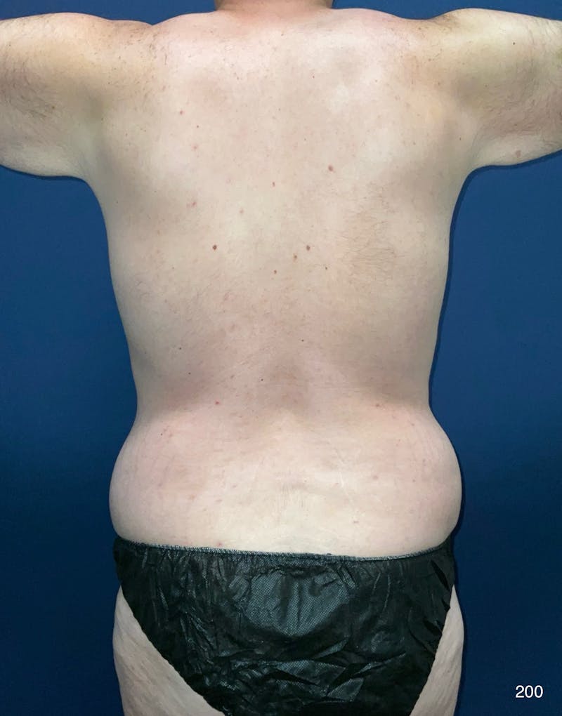 BodyTite/MorpheusBody Before & After Gallery - Patient 248727 - Image 3
