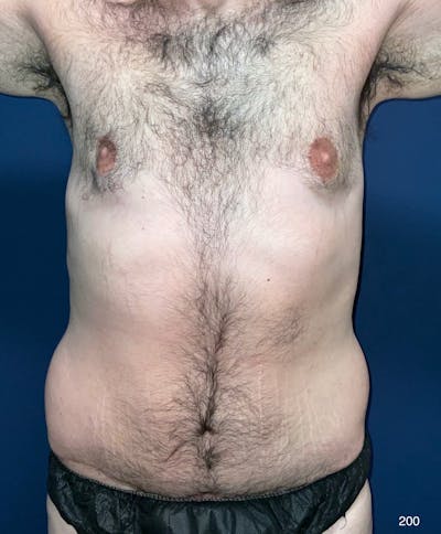 BodyTite/MorpheusBody Before & After Gallery - Patient 248727 - Image 1