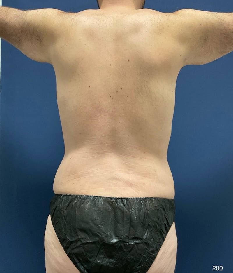BodyTite/MorpheusBody Before & After Gallery - Patient 248727 - Image 4