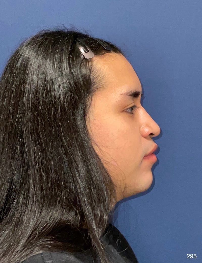 Rhinoplasty Before & After Gallery - Patient 320729 - Image 9