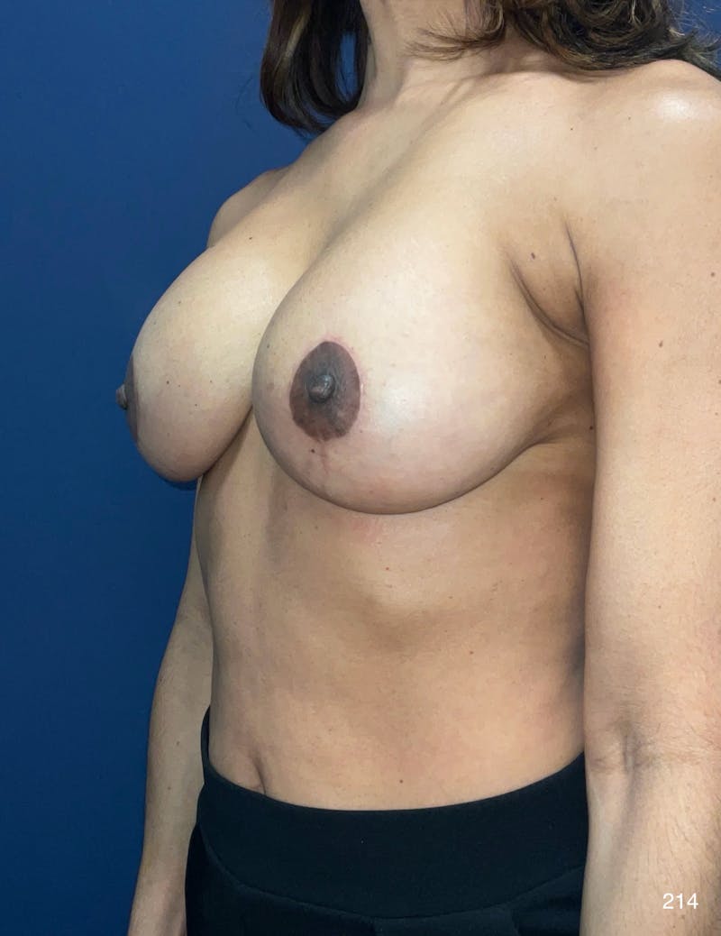 Capsulectomy Implant Exchange Before & After Gallery - Patient 136714 - Image 8