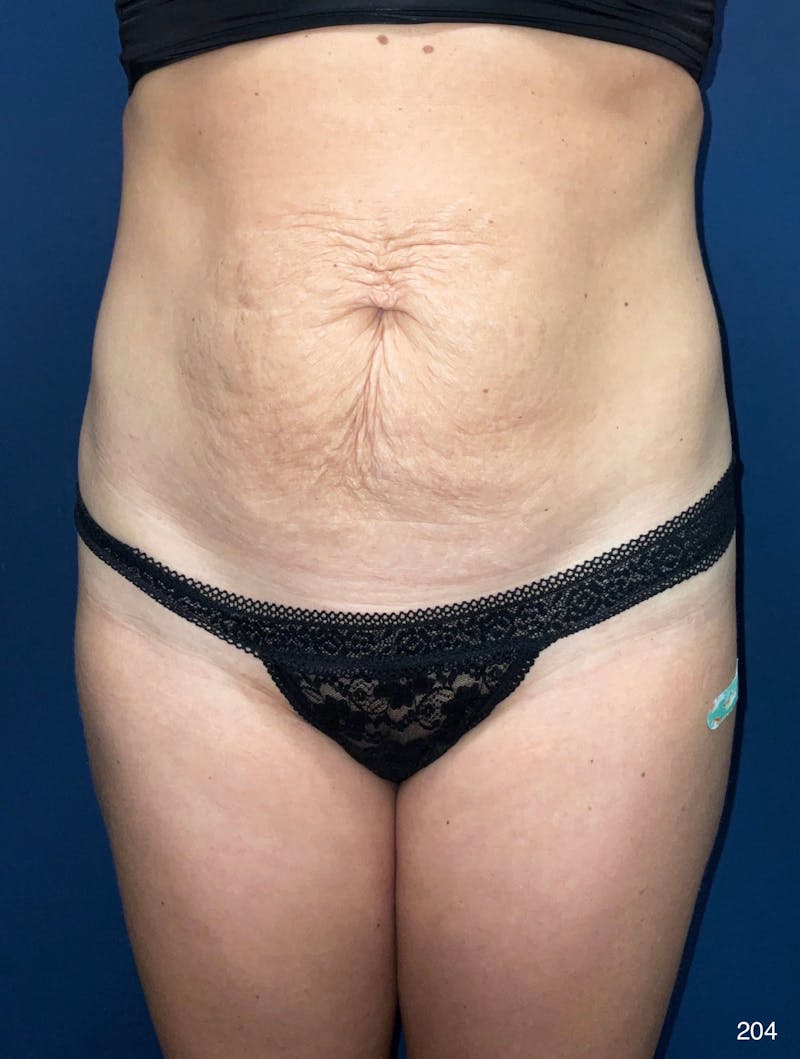 Tummy Tuck Before & After Gallery - Patient 818865 - Image 1
