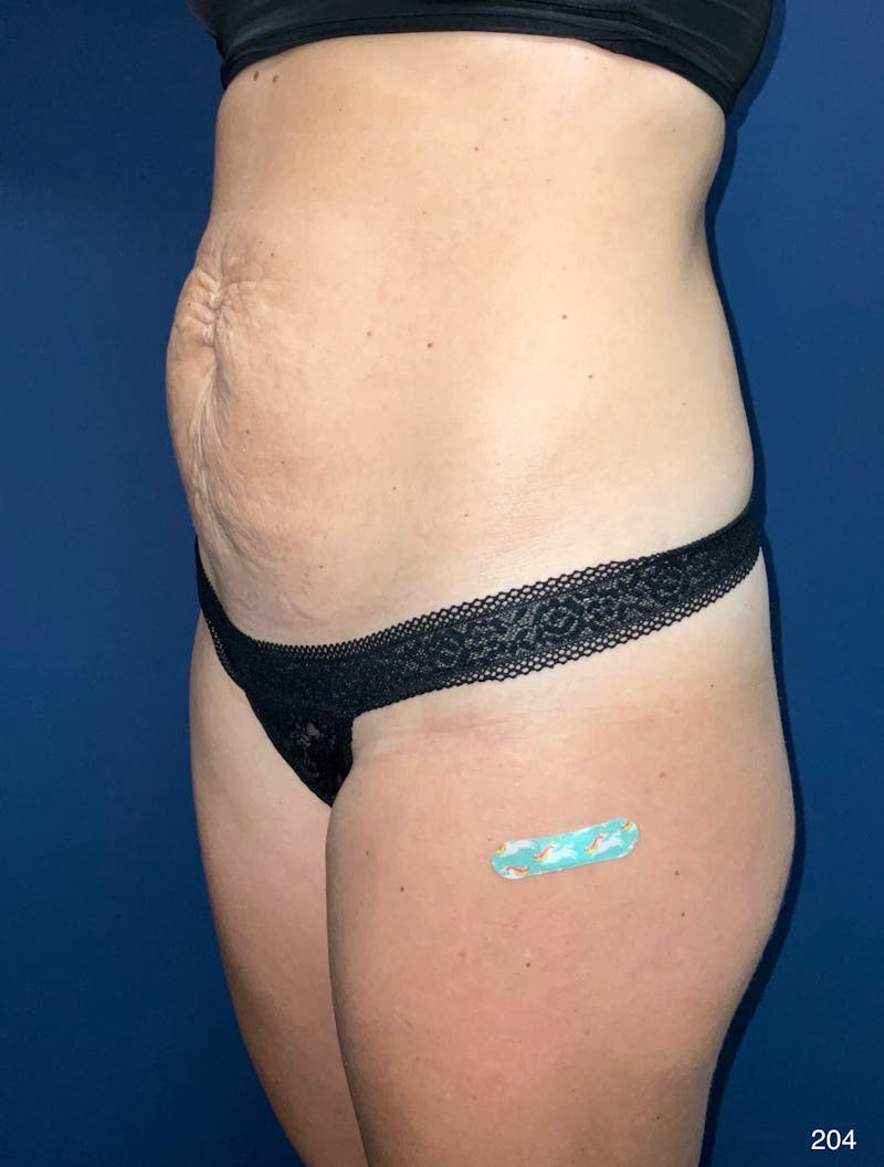Tummy Tuck Before & After Gallery - Patient 818865 - Image 8