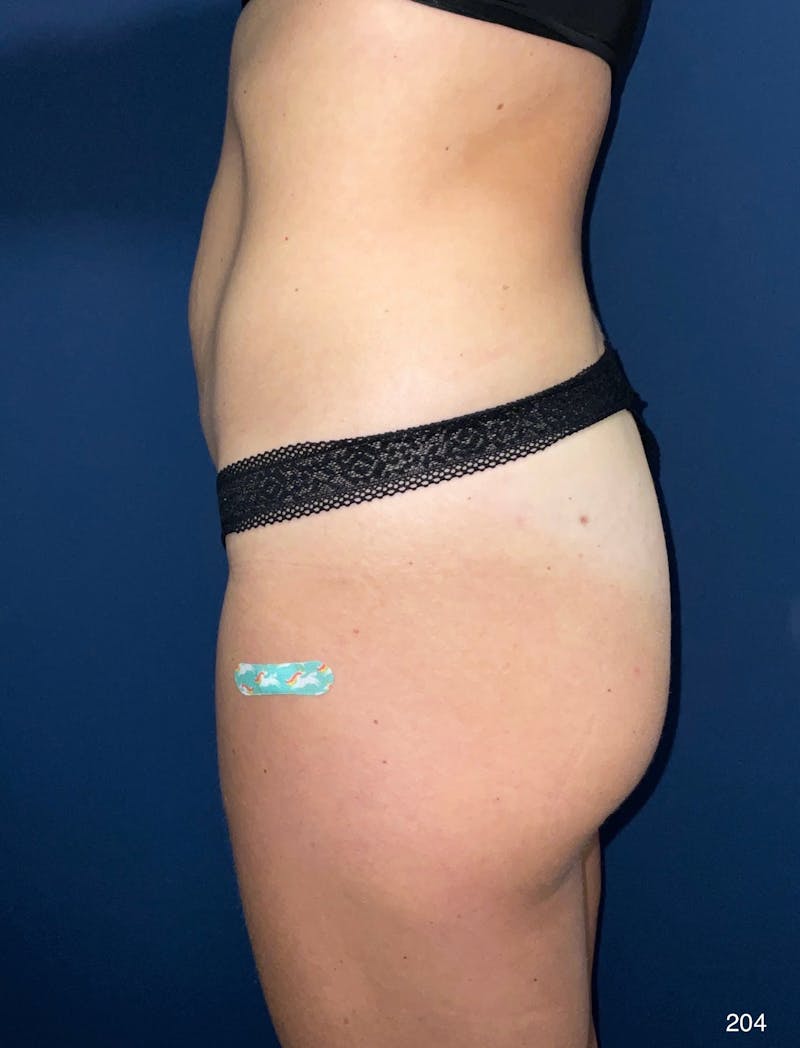 Tummy Tuck Before & After Gallery - Patient 818865 - Image 3