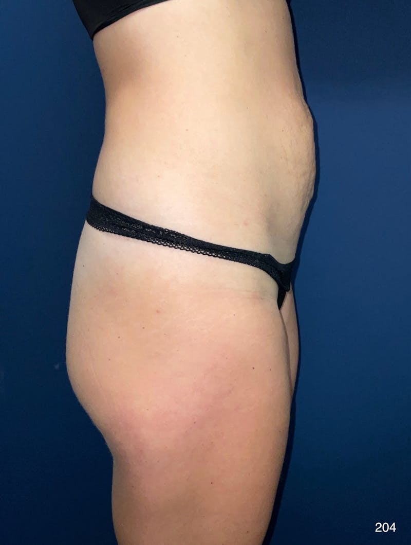 Tummy Tuck Before & After Gallery - Patient 818865 - Image 5