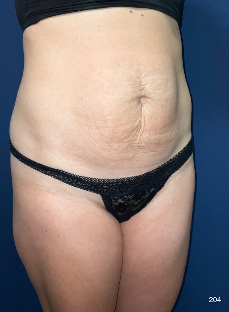 Tummy Tuck Before & After Gallery - Patient 818865 - Image 9