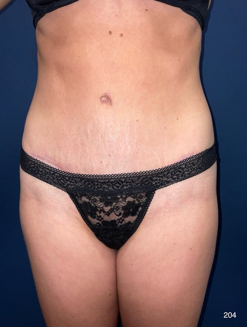 Tummy Tuck Before & After Gallery - Patient 818865 - Image 2