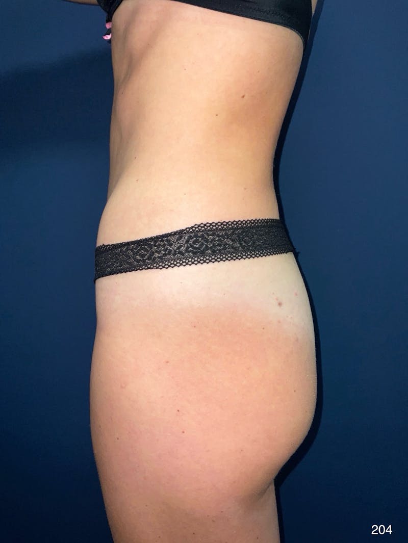 Tummy Tuck Before & After Gallery - Patient 818865 - Image 4