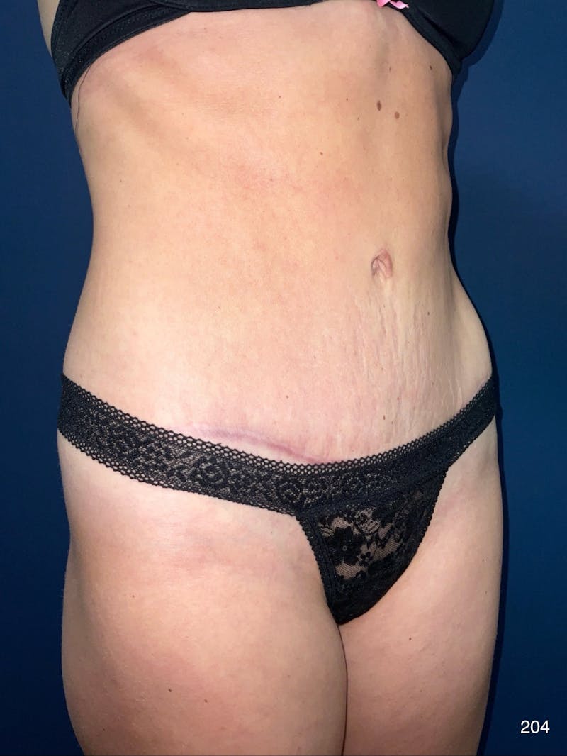 Tummy Tuck Before & After Gallery - Patient 818865 - Image 10