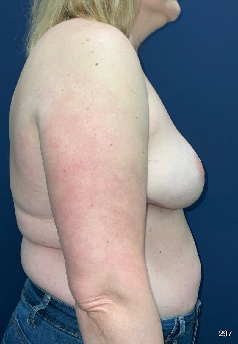Breast Lift Before & After Gallery - Patient 342517 - Image 6