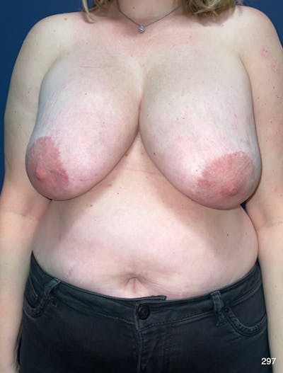 Breast Lift Before & After Gallery - Patient 342517 - Image 1
