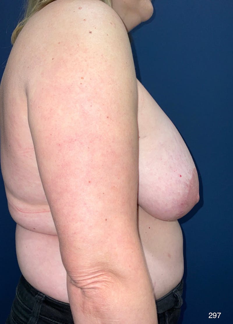 Breast Lift Before & After Gallery - Patient 342517 - Image 5