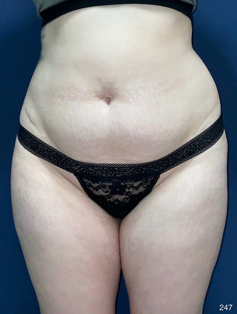 Tummy Tuck Before & After Gallery - Patient 214793 - Image 1