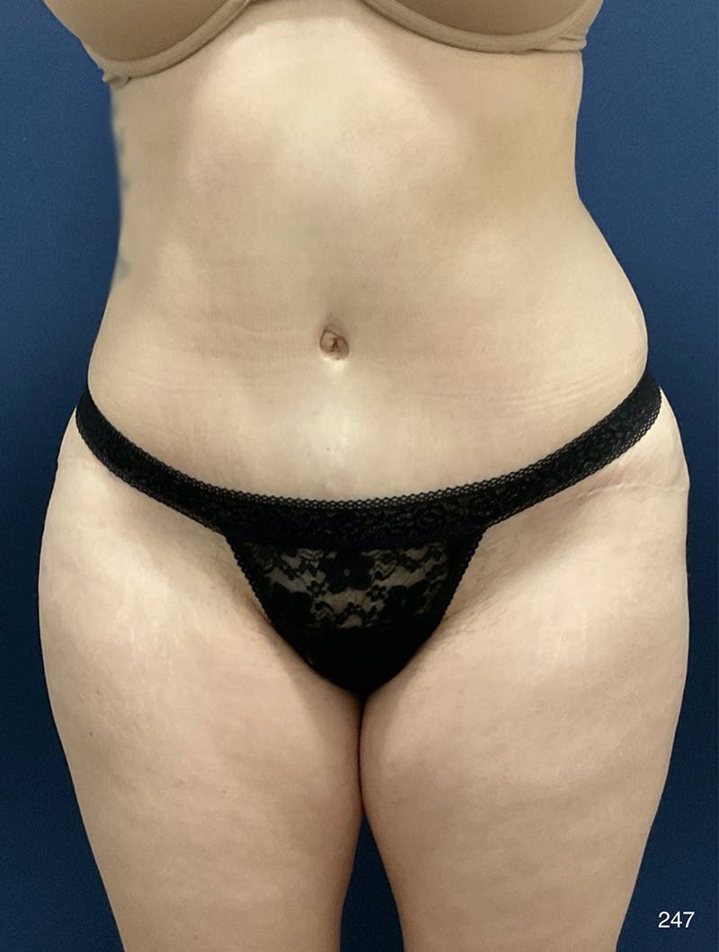 Tummy Tuck Before & After Gallery - Patient 214793 - Image 2