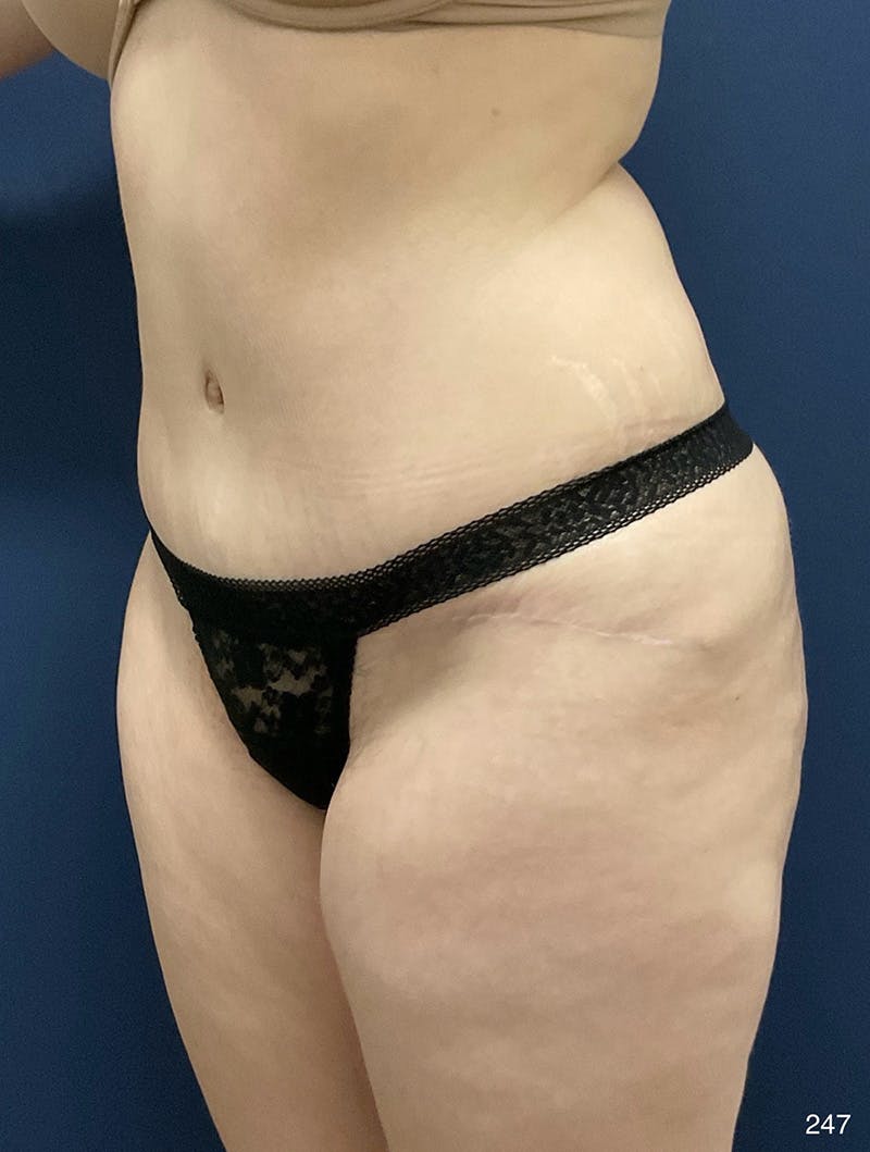 Tummy Tuck Before & After Gallery - Patient 214793 - Image 8