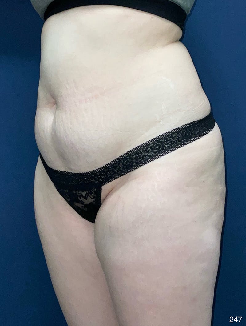 Tummy Tuck Before & After Gallery - Patient 214793 - Image 7