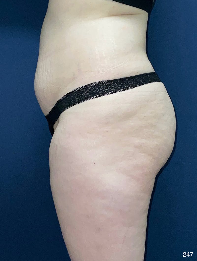 Tummy Tuck Before & After Gallery - Patient 214793 - Image 3