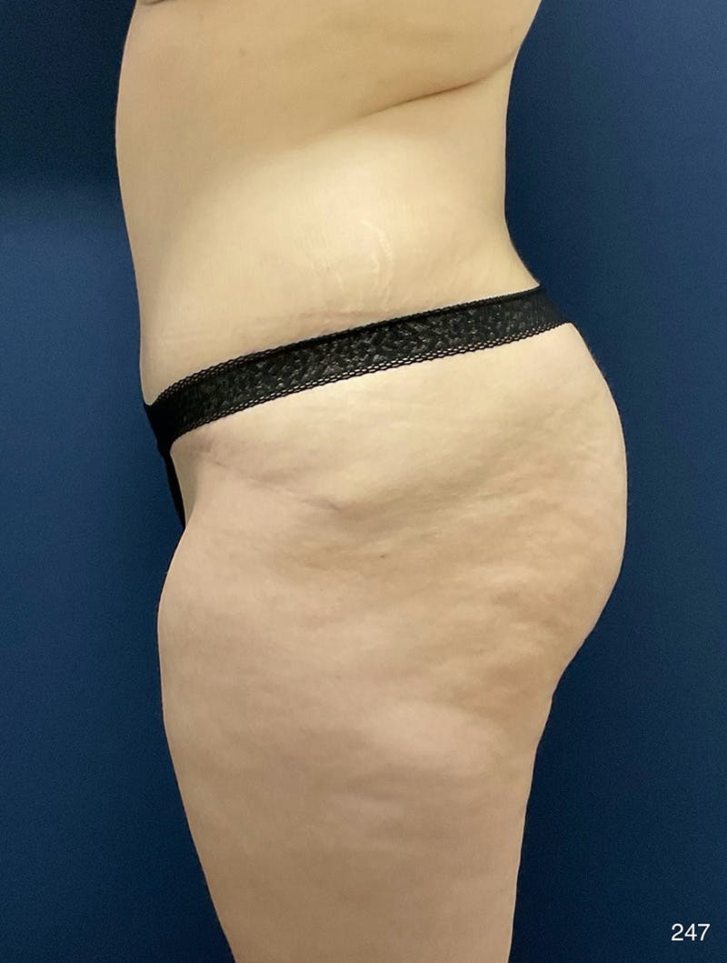 Tummy Tuck Before & After Gallery - Patient 214793 - Image 4
