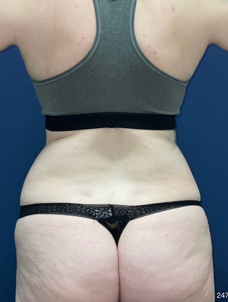 Tummy Tuck Before & After Gallery - Patient 214793 - Image 5