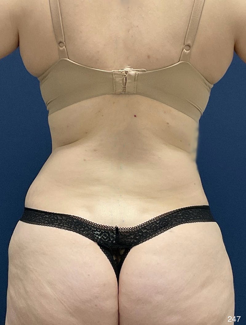 Tummy Tuck Before & After Gallery - Patient 214793 - Image 6