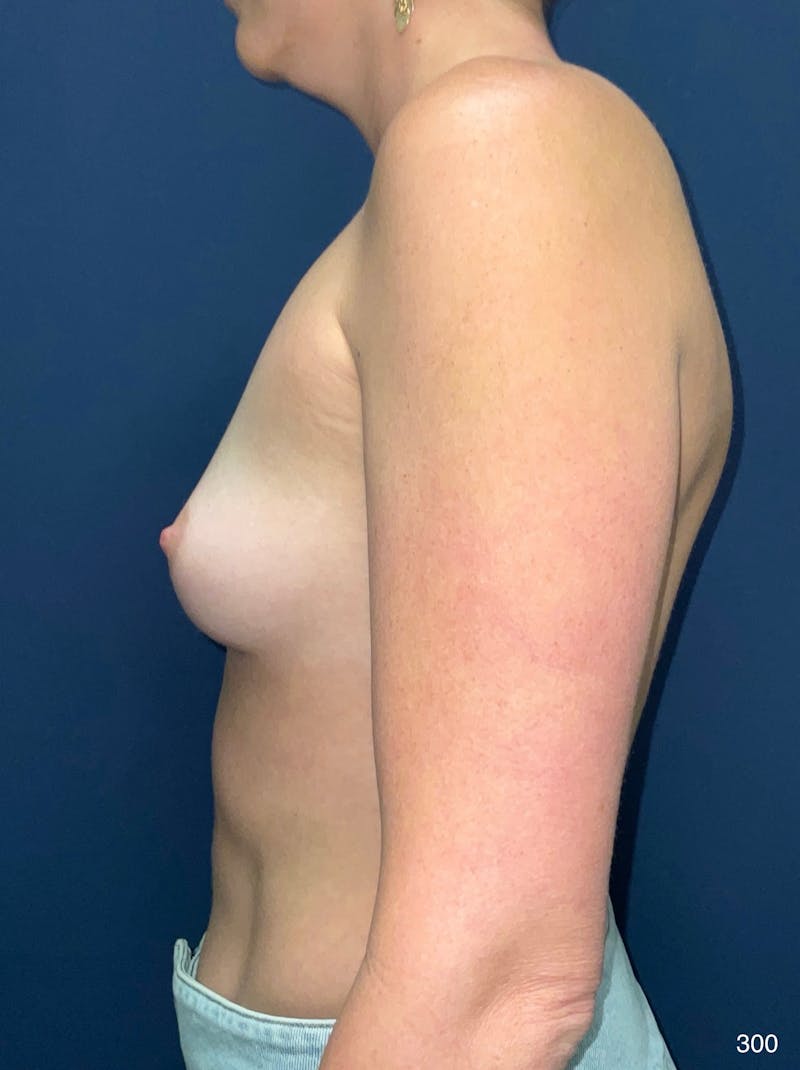 Breast Augmentation Before & After Gallery - Patient 283118 - Image 5