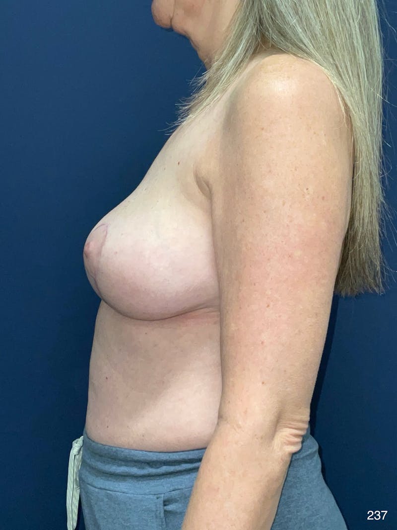 Implant Removal Before & After Gallery - Patient 401745 - Image 6