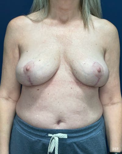Implant Removal Before & After Gallery - Patient 401745 - Image 2