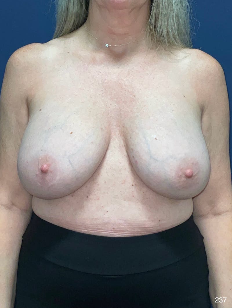 Implant Removal Before & After Gallery - Patient 401745 - Image 1