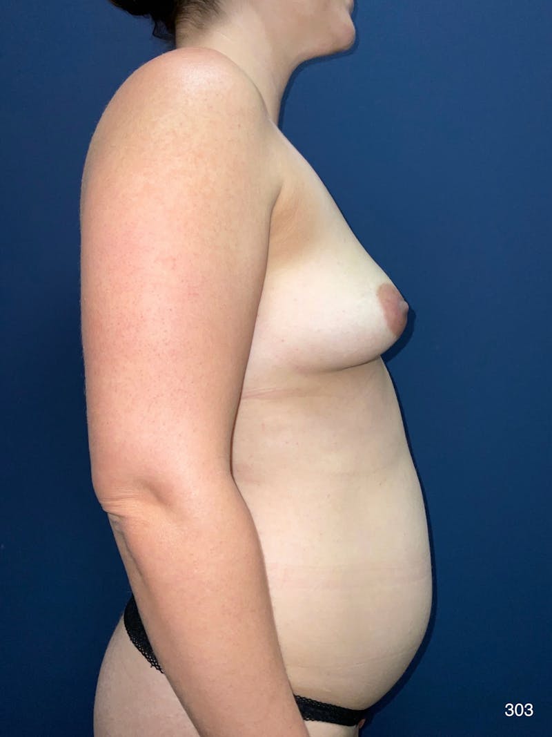 Fat Grafting to Breasts Before & After Gallery - Patient 890711 - Image 3