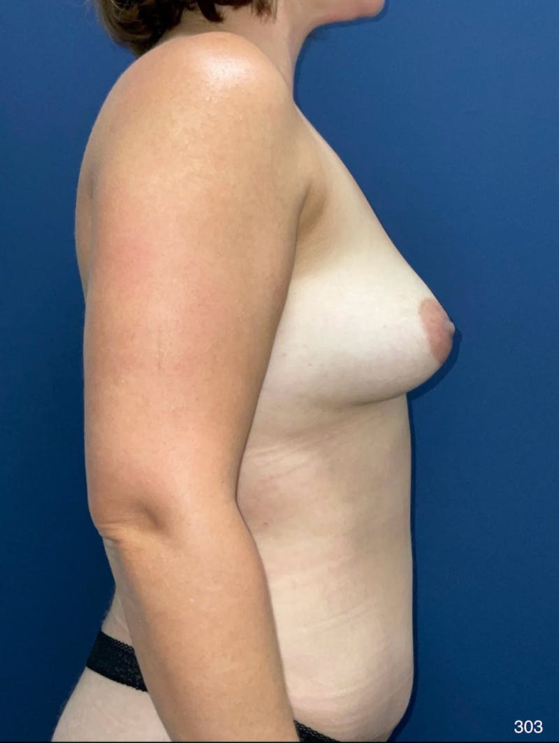 Fat Grafting to Breasts Before & After Gallery - Patient 890711 - Image 4