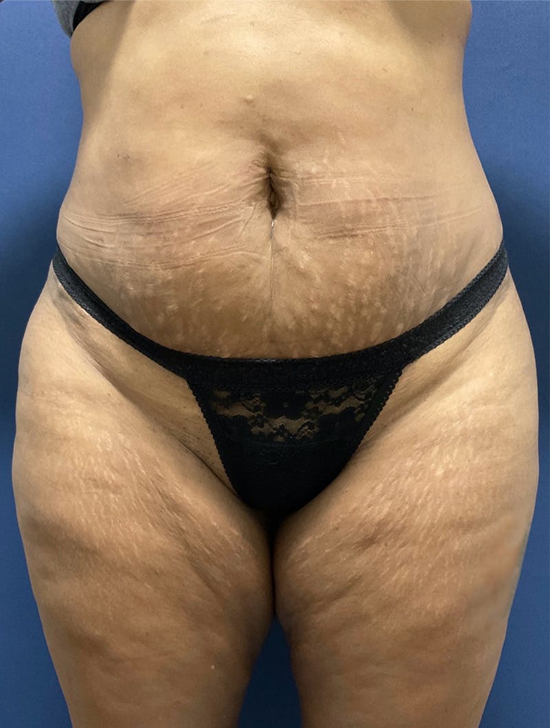 Tummy Tuck Before & After Gallery - Patient 377823 - Image 1