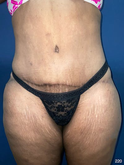 Tummy Tuck Before & After Gallery - Patient 377823 - Image 2