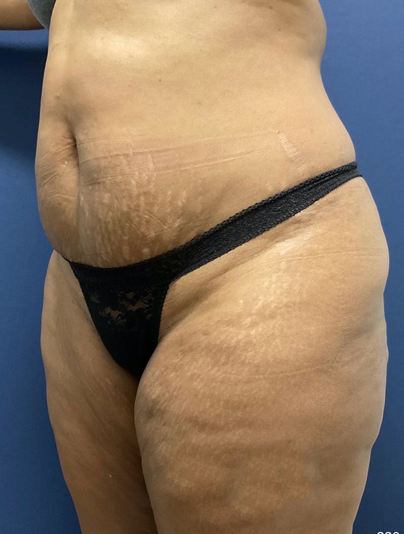 Tummy Tuck Before & After Gallery - Patient 377823 - Image 7
