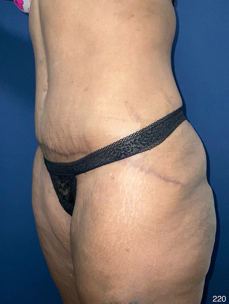 Tummy Tuck Before & After Gallery - Patient 377823 - Image 8