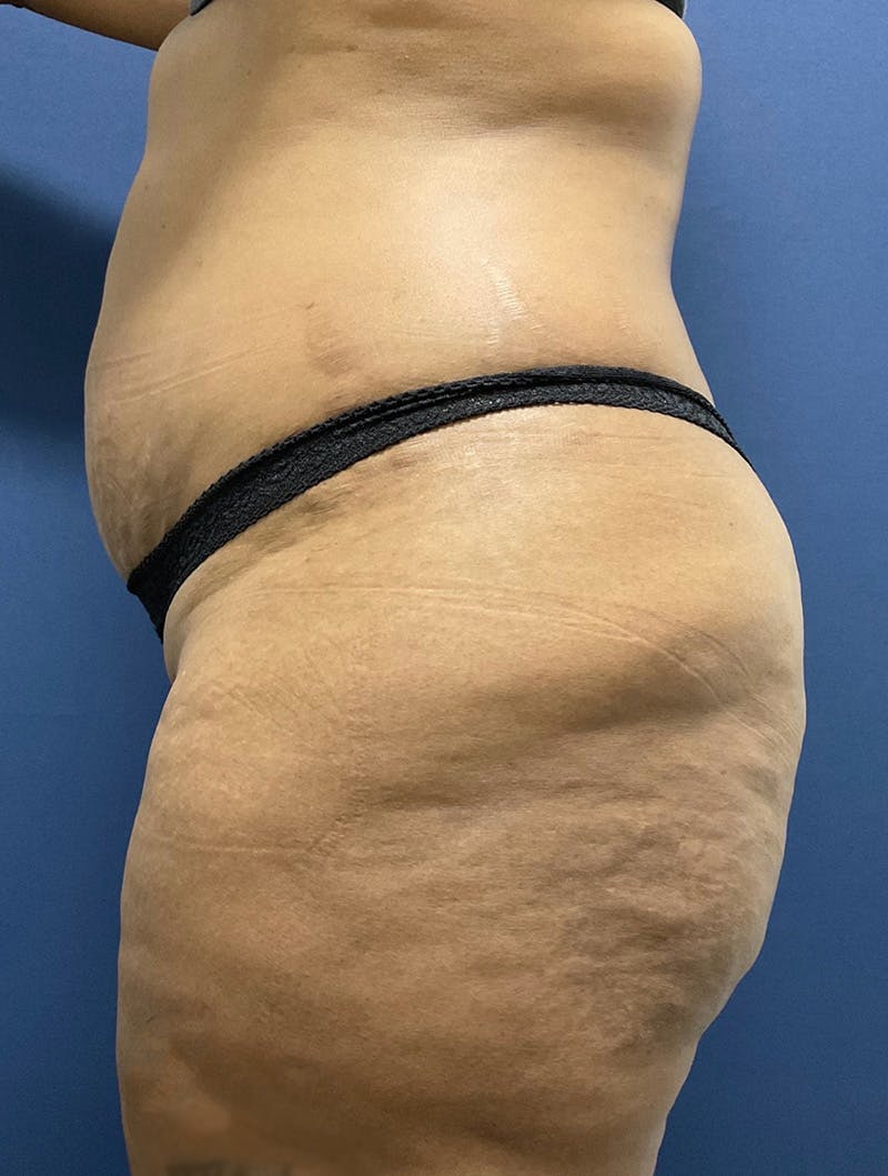 Tummy Tuck Before & After Gallery - Patient 377823 - Image 3