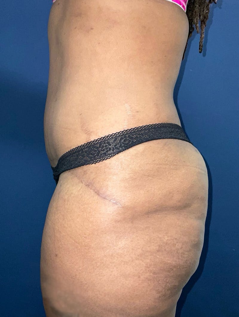 Tummy Tuck Before & After Gallery - Patient 377823 - Image 4