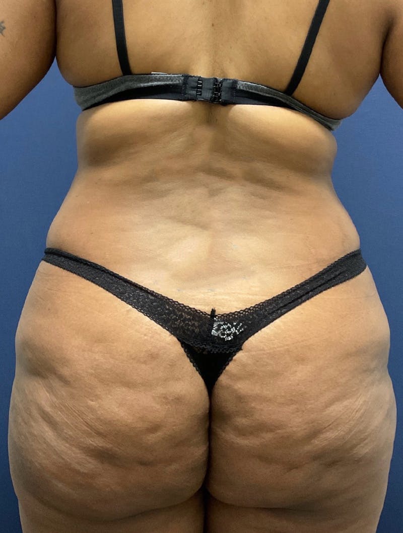 Tummy Tuck Before & After Gallery - Patient 377823 - Image 5