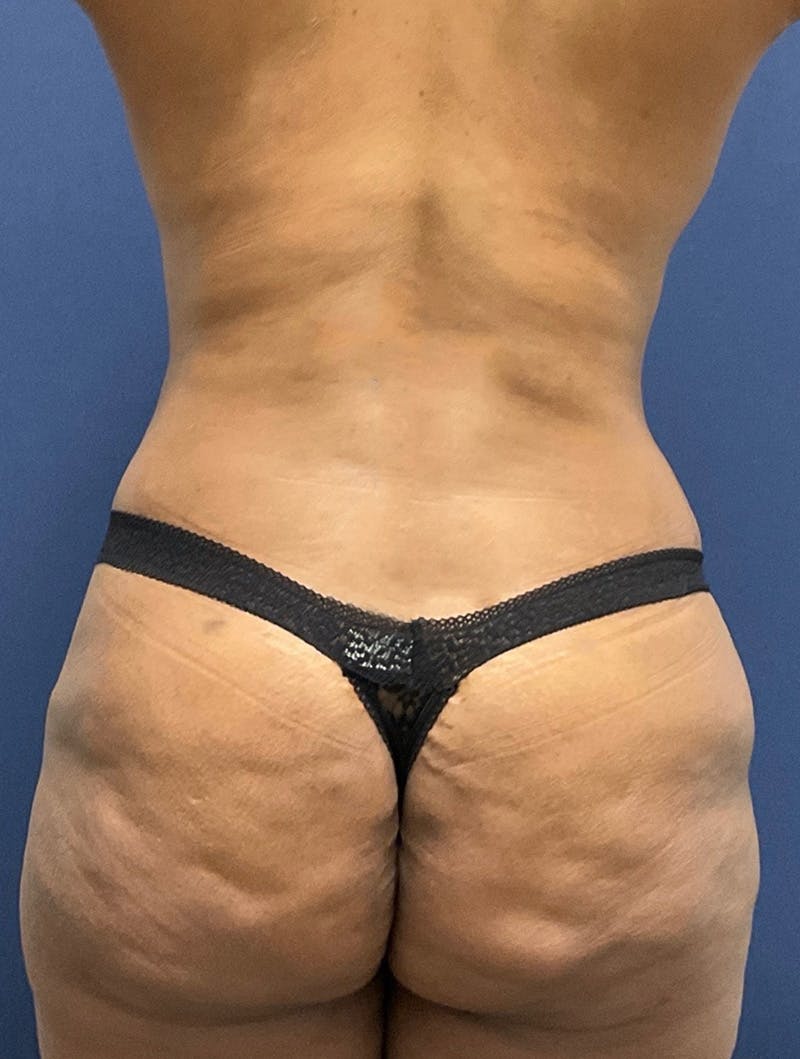 Tummy Tuck Before & After Gallery - Patient 377823 - Image 6