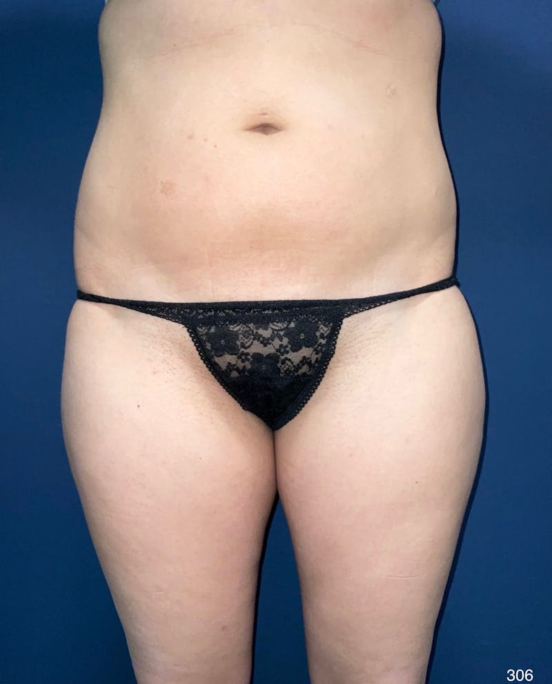Liposuction Before & After Gallery - Patient 119273 - Image 1