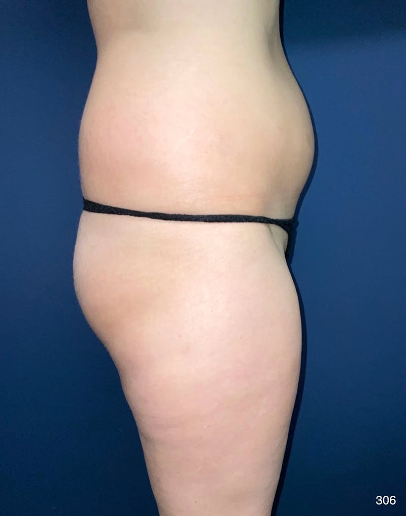 Liposuction Before & After Gallery - Patient 119273 - Image 5