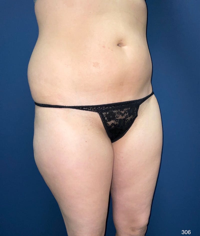 BodyTite/MorpheusBody Before & After Gallery - Patient 556059 - Image 7