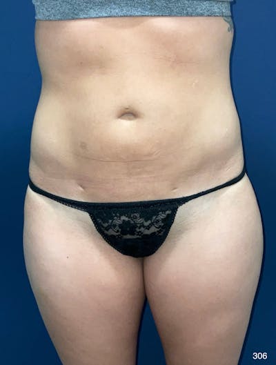 Liposuction Before & After Gallery - Patient 119273 - Image 2