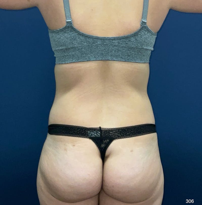 Liposuction Before & After Gallery - Patient 119273 - Image 4